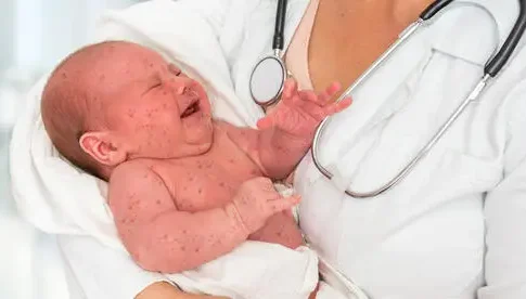 Младенец умер от кори в Иерусалиме: 14-я жертва эпидемии